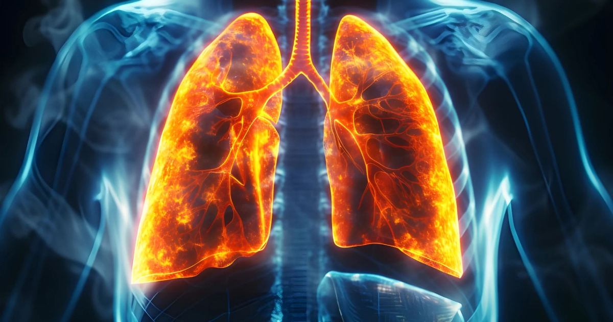 The Value of soluble Interleukin-2 Receptor (sIl-2R) as a Diagnostic and Predictive Biomarker